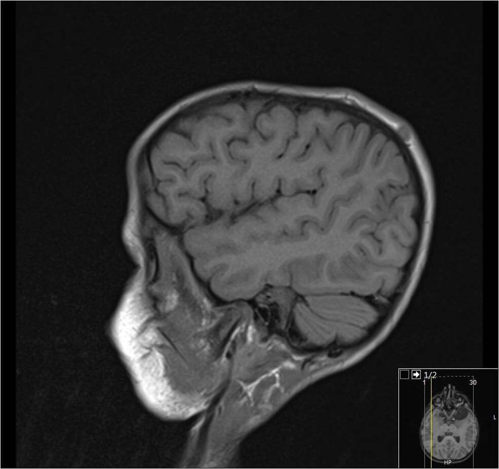 MRI head- scalp lesions